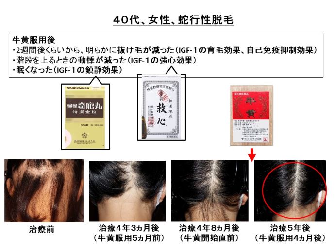 円形脱毛症　病院